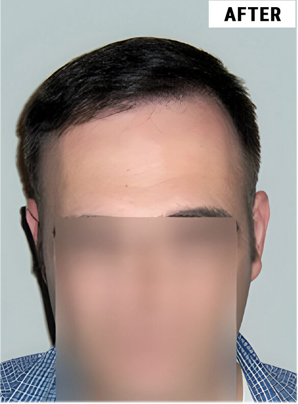 Hair Transplant 2368 grafts FUE