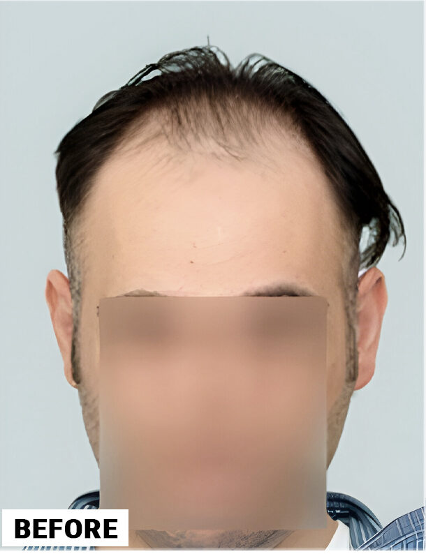 Hair Transplant 2368 grafts FUE