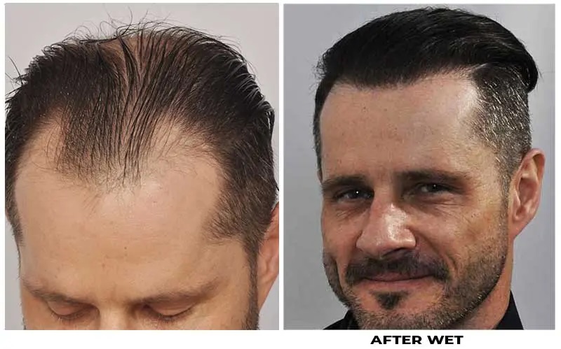 Hair transplant 3957 grafts FUE left