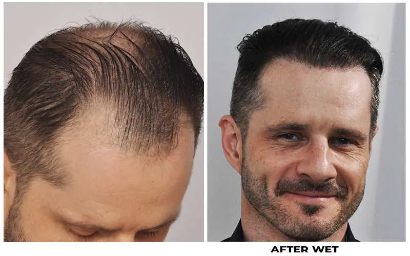 Hair transplant 3957 grafts FUE right