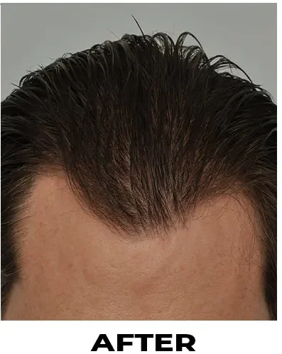 FUE 1845 grafts before & after featured