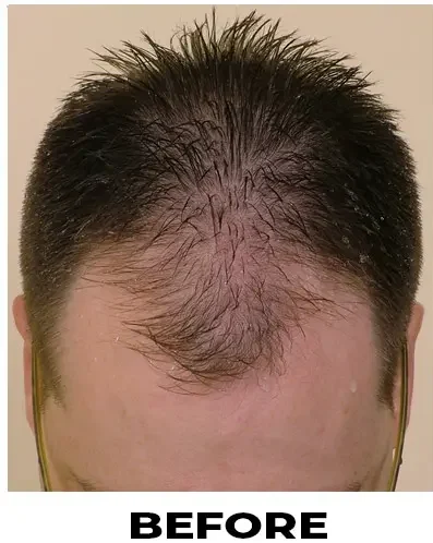FUE 1845 grafts before & after featured