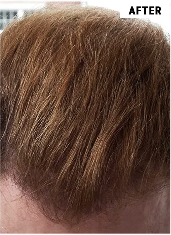 Hair Transplant 3007 grafts FUE