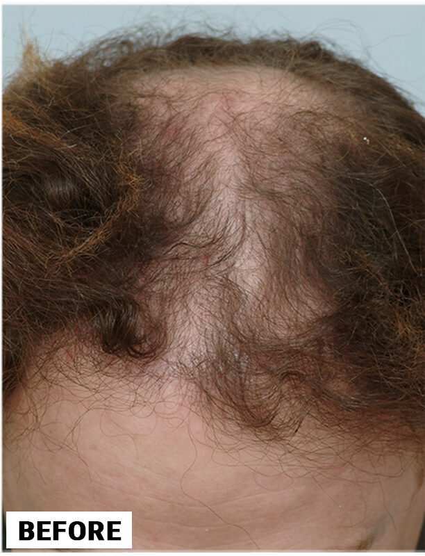 Hair Transplant 3007 grafts FUE