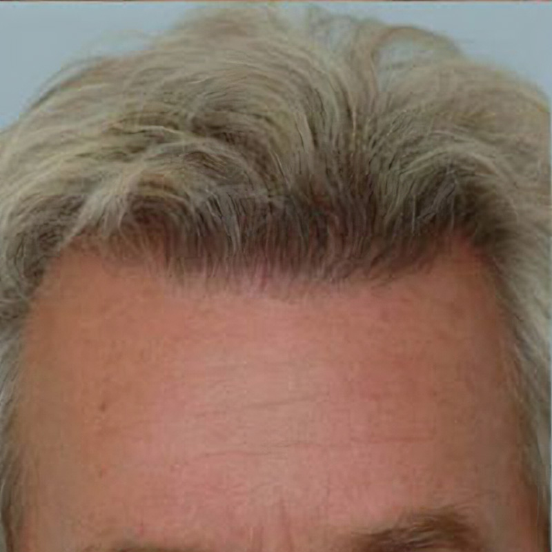 Hair transplant 1500 grafts FUE