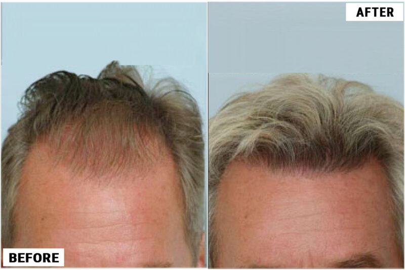 Hair transplant 1500 grafts FUE front