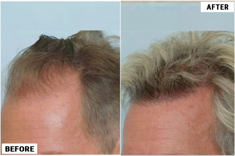 Hair transplant 1500 grafts FUE left