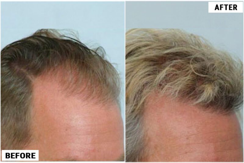 Hair transplant 1500 grafts FUE right