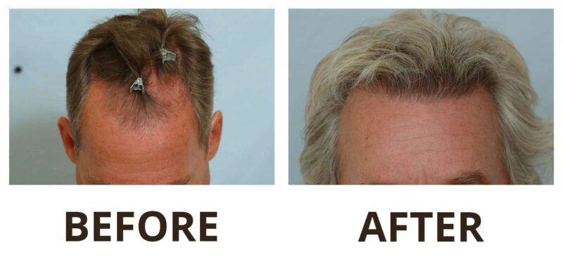 Hair transplant 1500 grafts FUE top