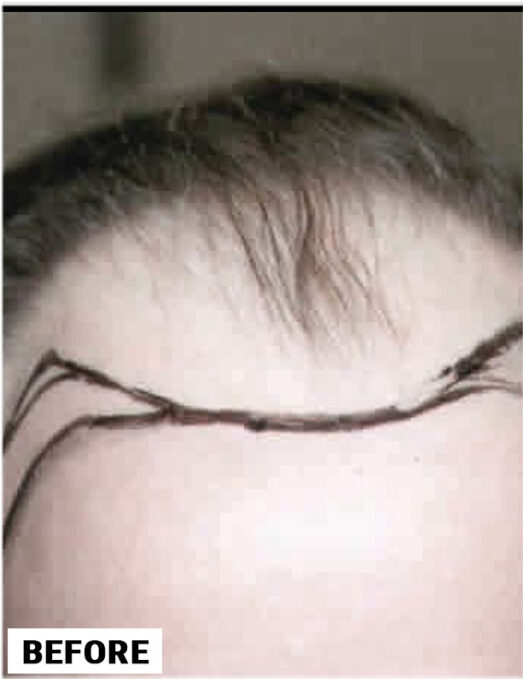 Hair Transplant 1800 grafts FUT