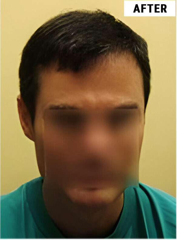 Hair Transplant 2146 grafts FUE