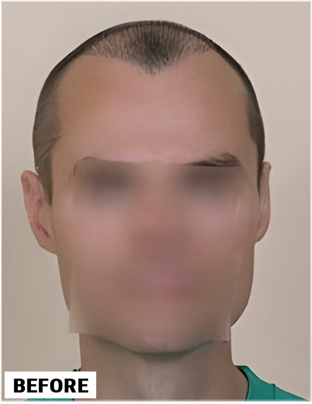 Hair Transplant 2146 grafts FUE