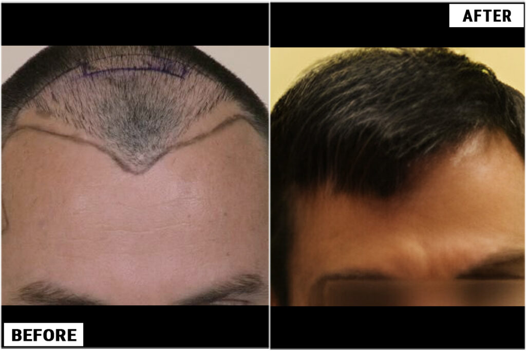 Before hair line design & after