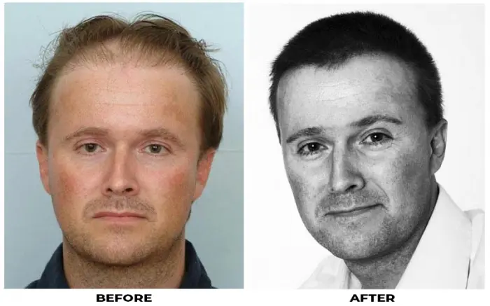 Hair Transplant 1654 grafts FUE