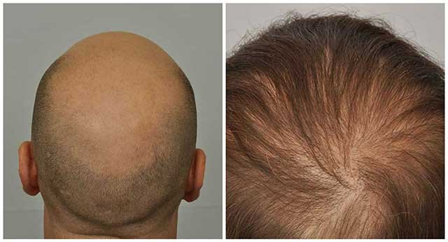 before after crown