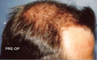 Hair Transplant 1500 grafts FUE