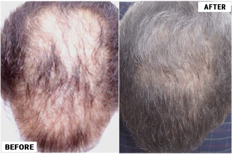 FUE 2700 grafts top