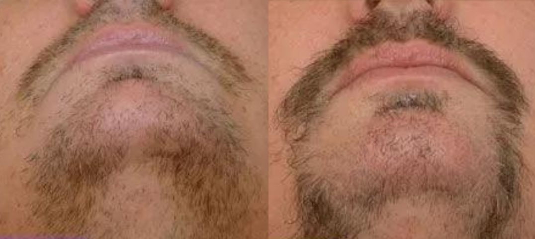 Beard Hair Transplant Before And After