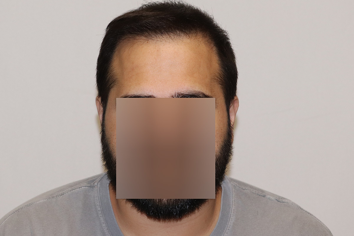 FUE 3982 featured before and after