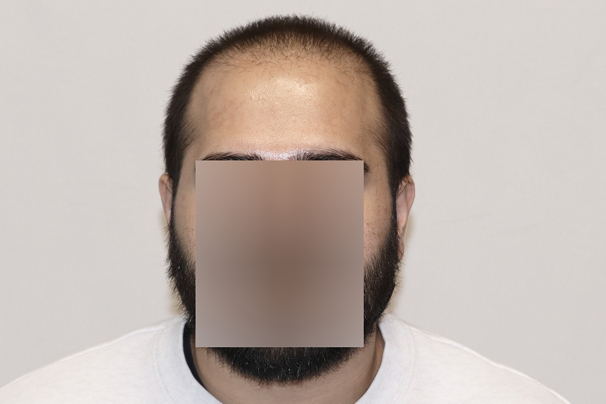 FUE 3982 featured before and after