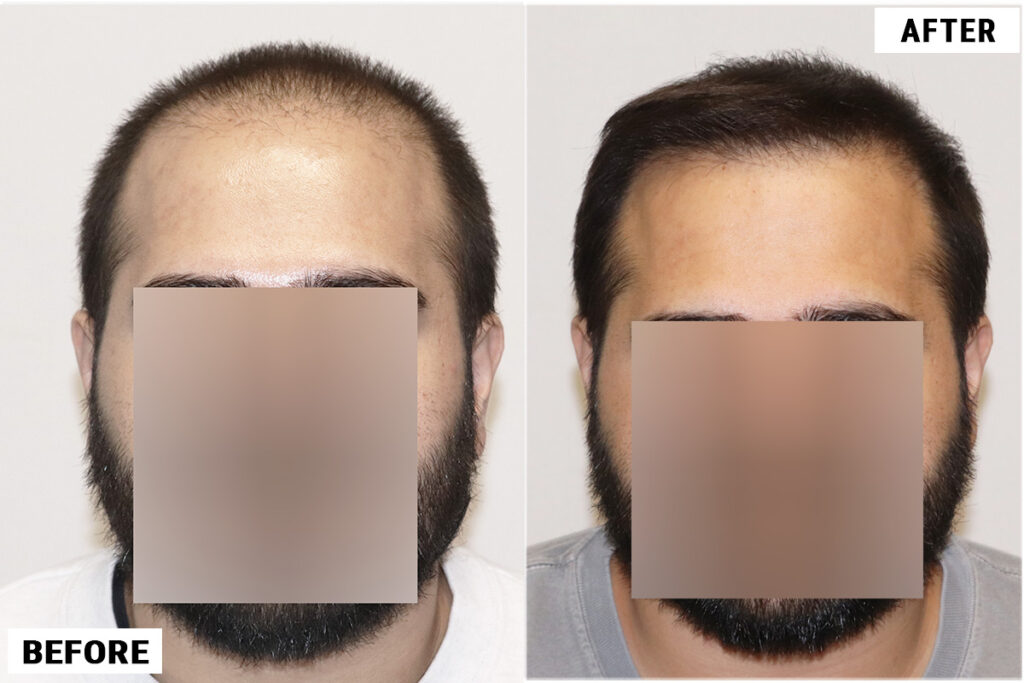 FUE 3982 featured before and after