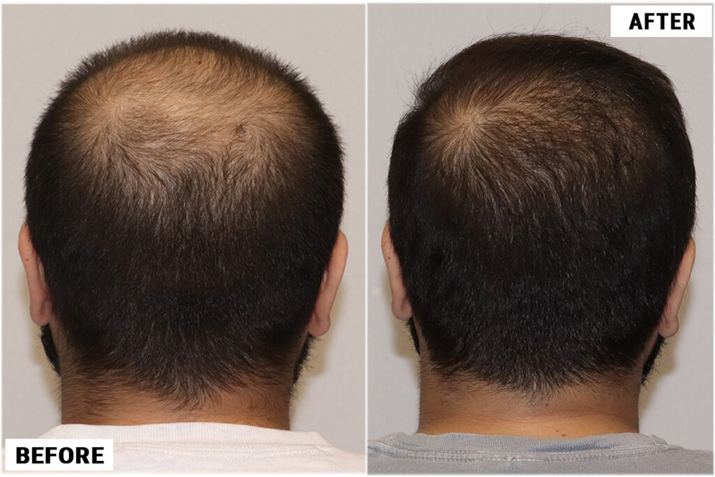 FUE 3982 Grafts Back