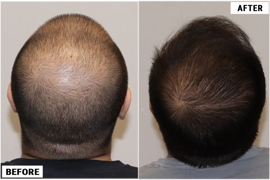 FUE 3982 Grafts - Crown