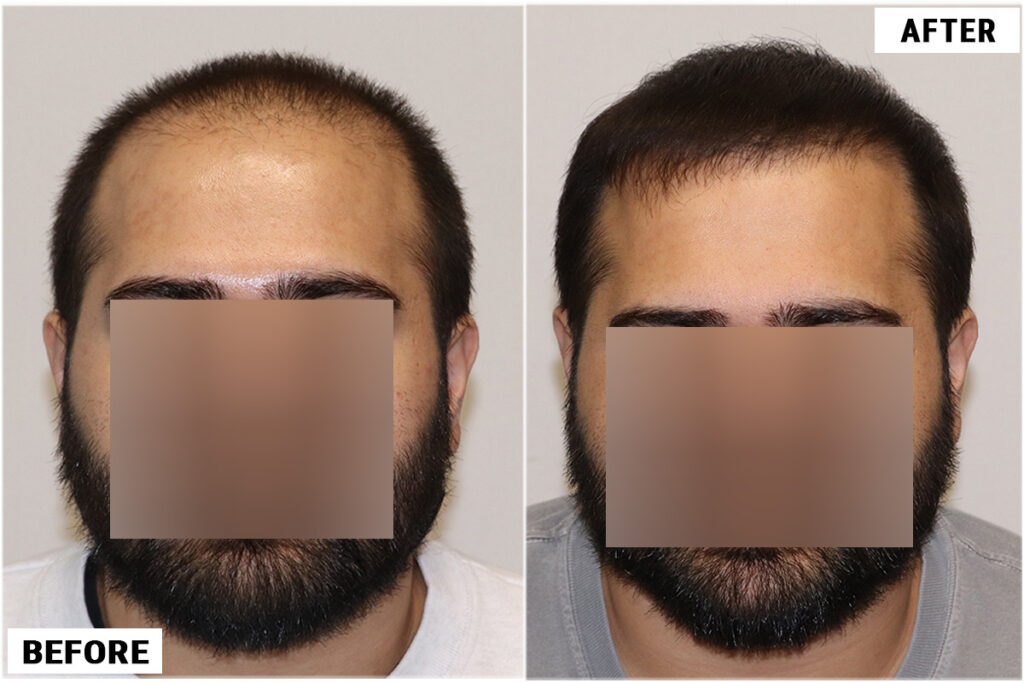 FUE 3982 Grafts - front