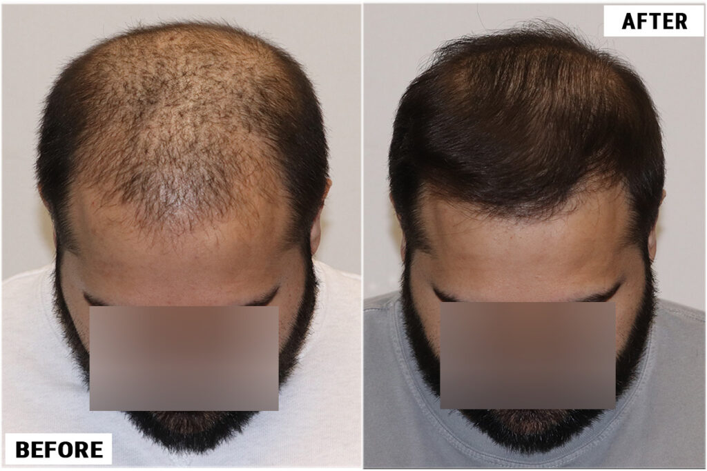 FUE 3982 Grafts Top View