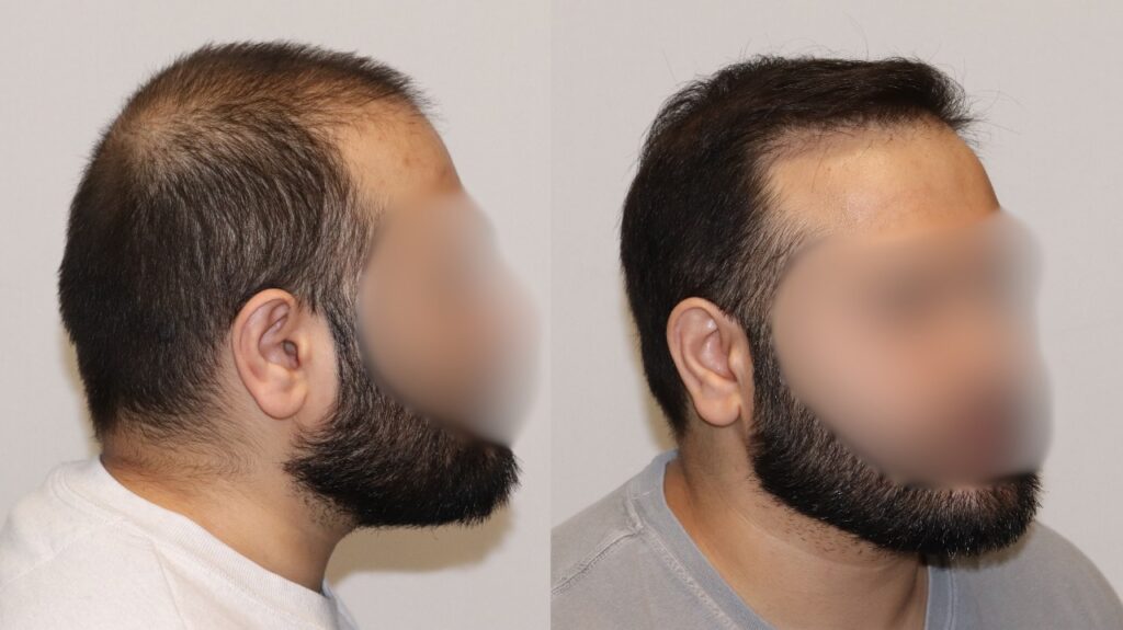 FUE 3982 Grafts - Right