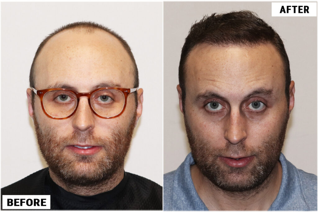 Before and after FUE front