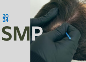 SMP treatment for hair loss