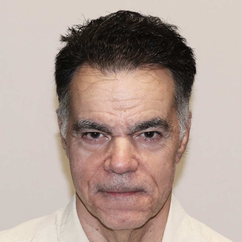 3085 grafts FUE featured