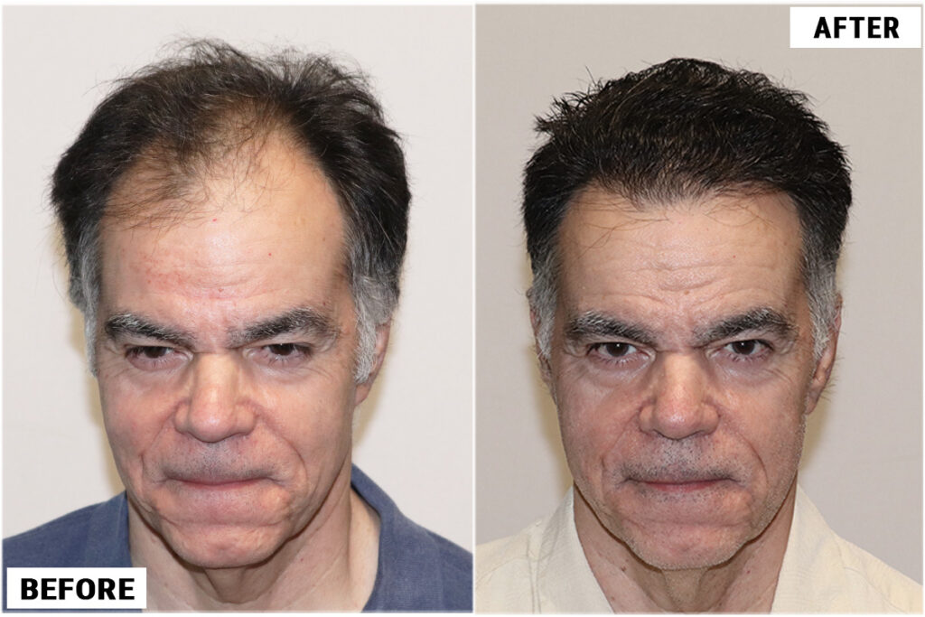 Before and after FUE front