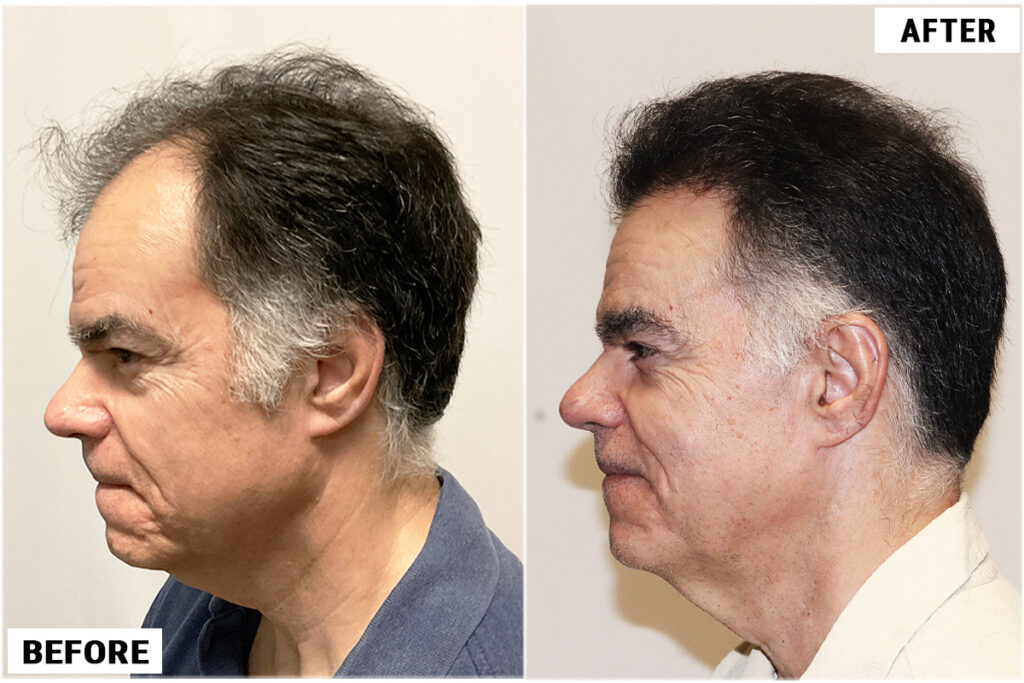 before and after left 2