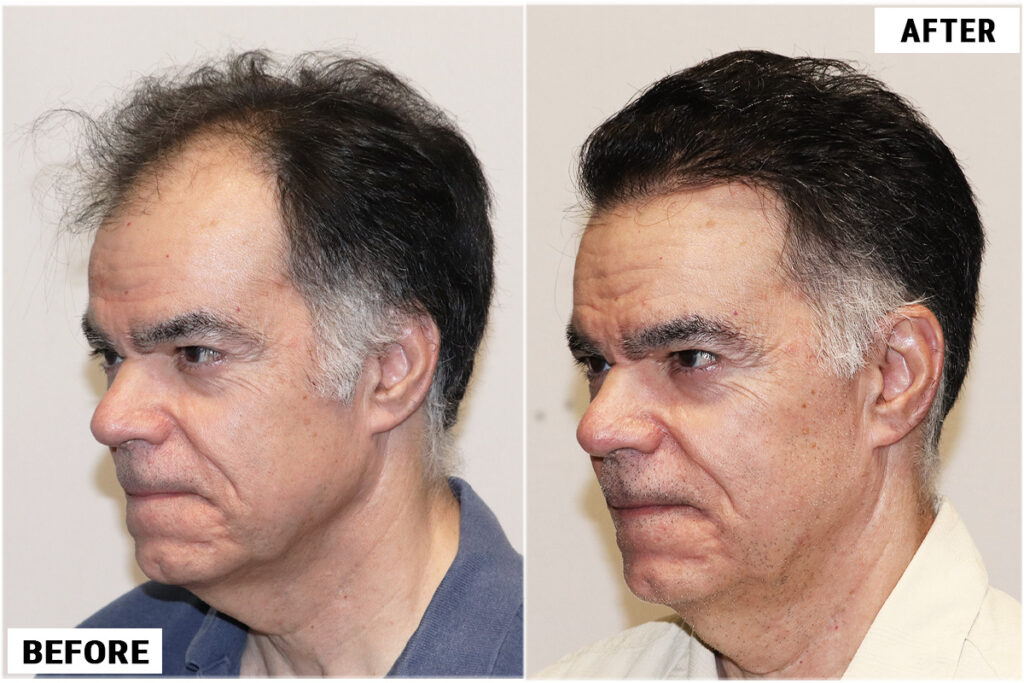 Before and after FUE left 1