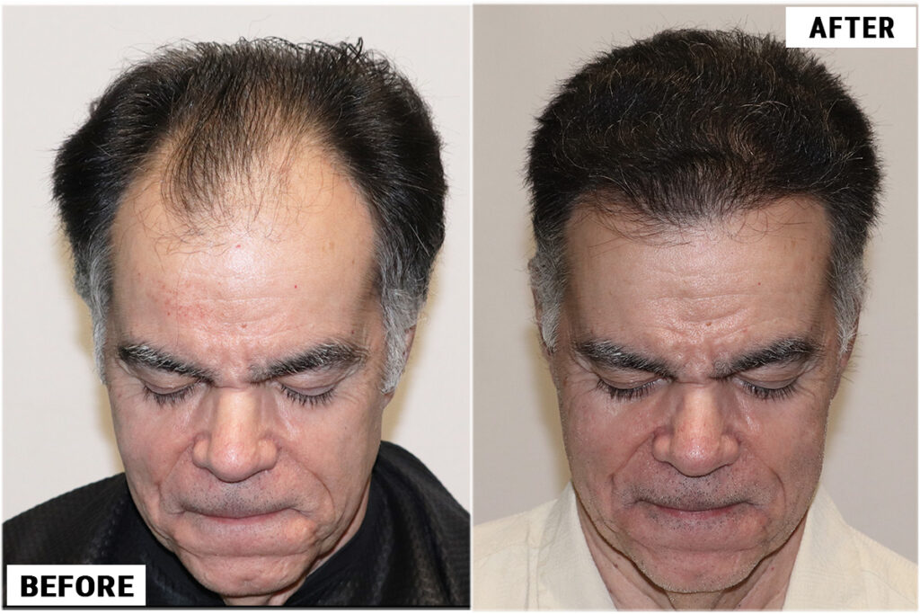 Before and after FUE top 1