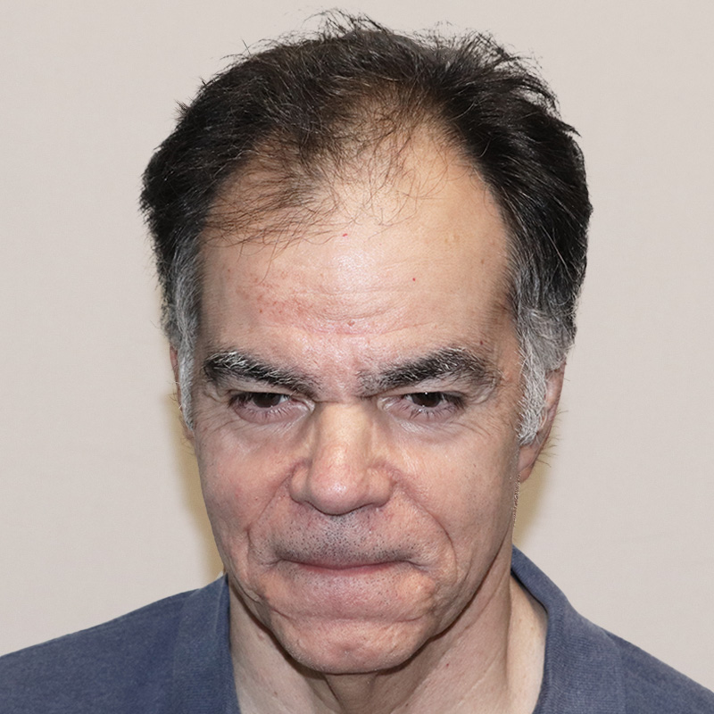 3085 grafts FUE featured