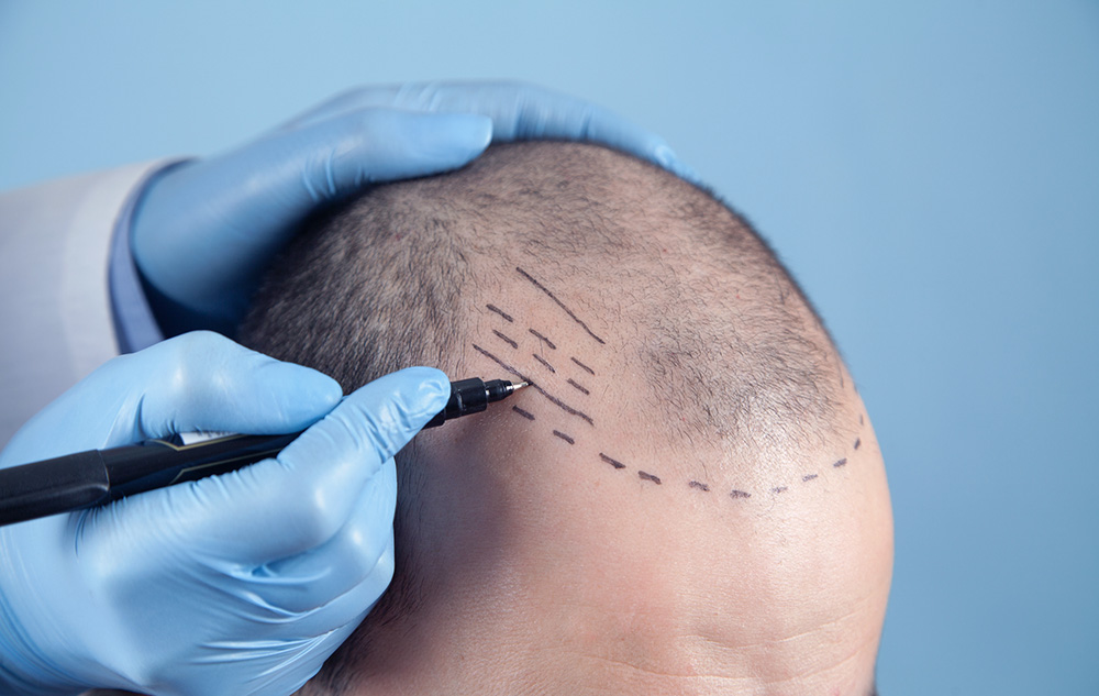 SMP doctor planning hairline