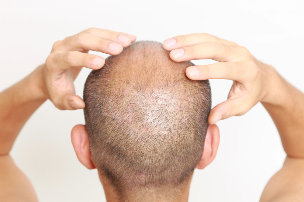 Bald crown male patient