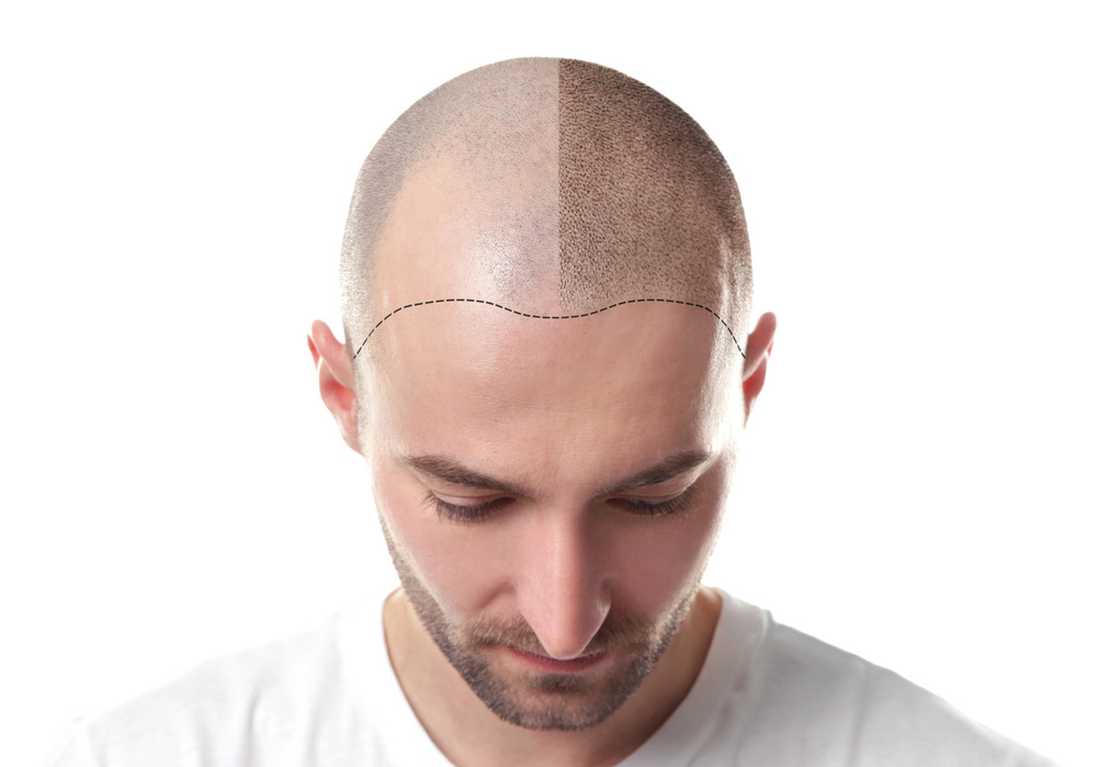 SMP before and after results