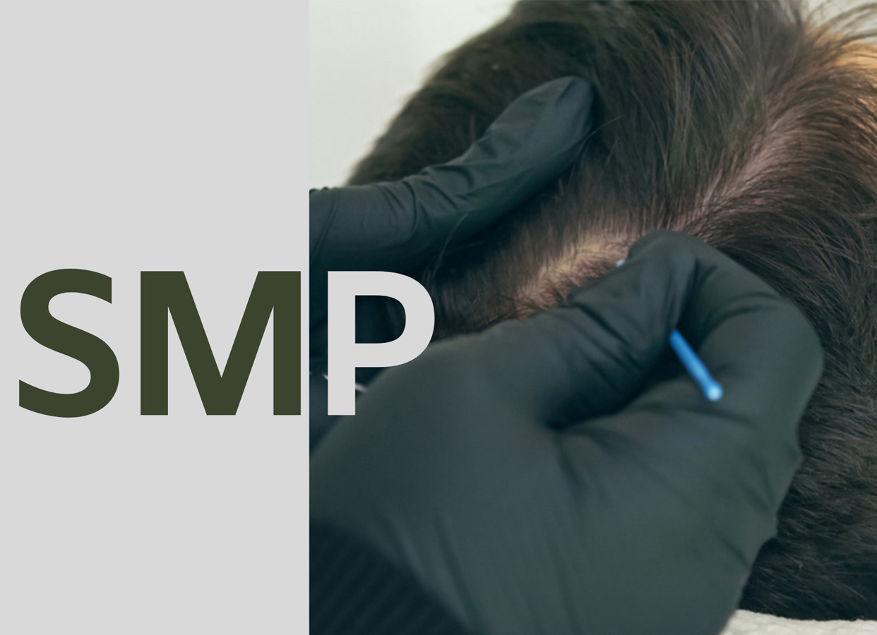 SMP treatment for hair loss