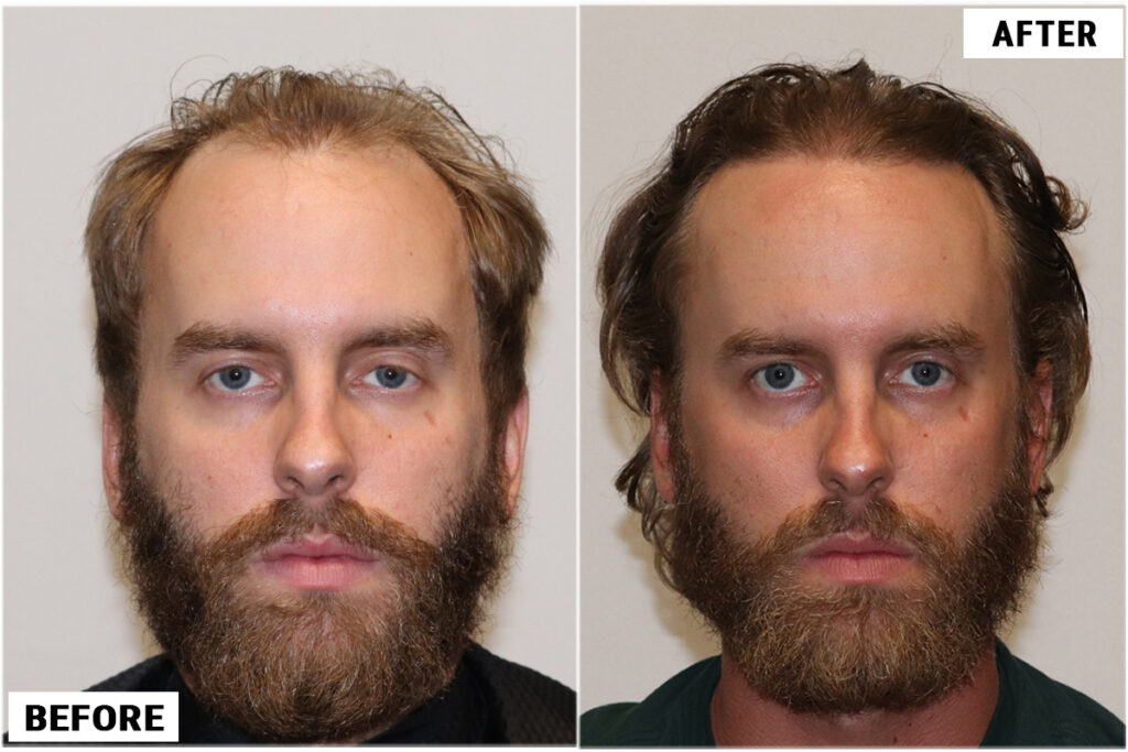 Before & after FUE front