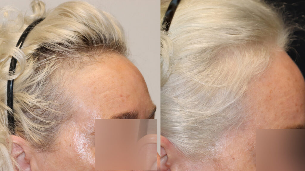 Before and after left view comparison