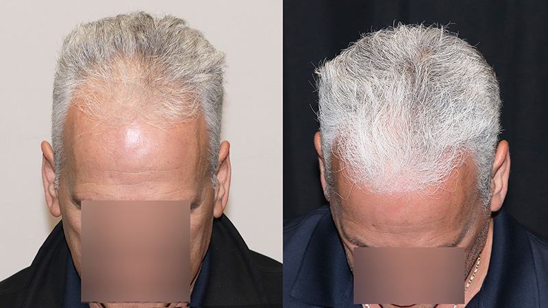 Dutasteride results featured