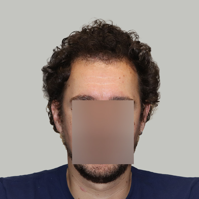 2176 FUE grafts - Front