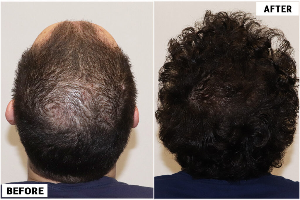 2176 FUE grafts - Crown