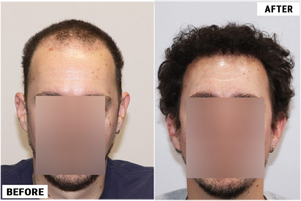 2176 FUE grafts - Front