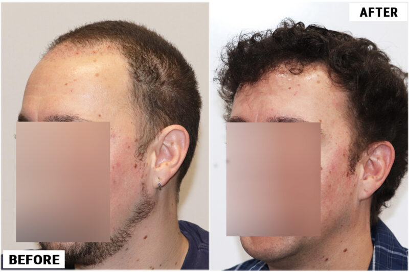 2176 FUE grafts - Left
