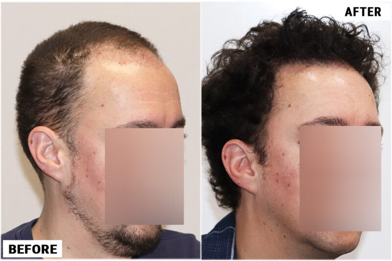 2176 FUE grafts - Right